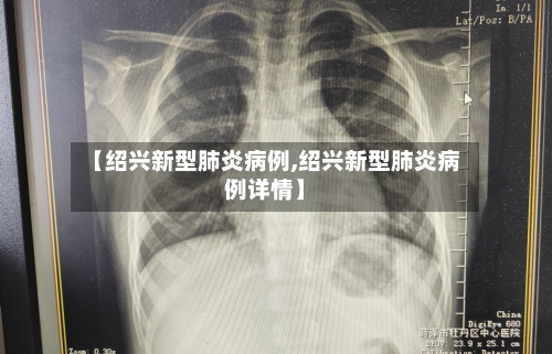 【绍兴新型肺炎病例,绍兴新型肺炎病例详情】-第2张图片
