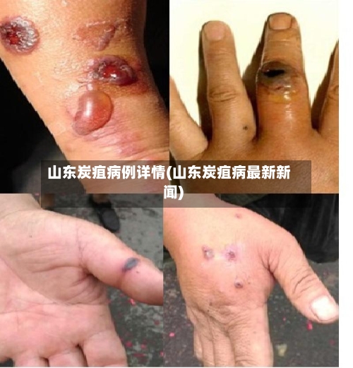 山东炭疽病例详情(山东炭疽病最新新闻)-第2张图片