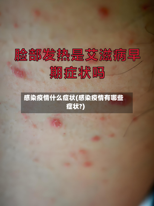 感染疫情什么症状(感染疫情有哪些症状?)-第2张图片