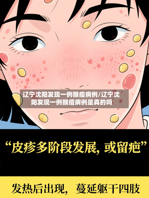 辽宁沈阳发现一例猴痘病例/辽宁沈阳发现一例猴痘病例是真的吗-第2张图片