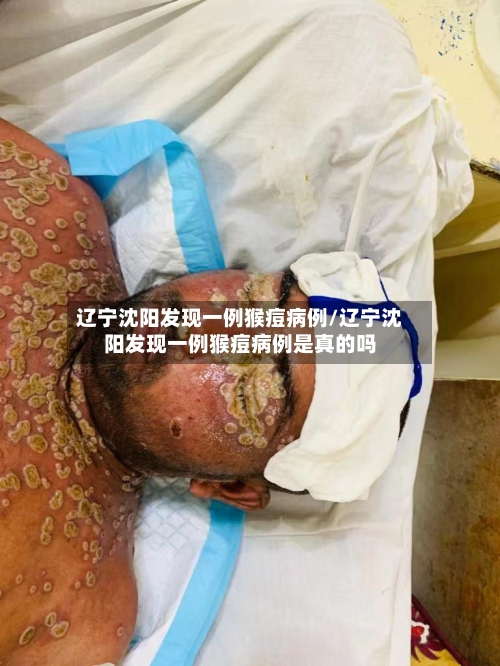 辽宁沈阳发现一例猴痘病例/辽宁沈阳发现一例猴痘病例是真的吗