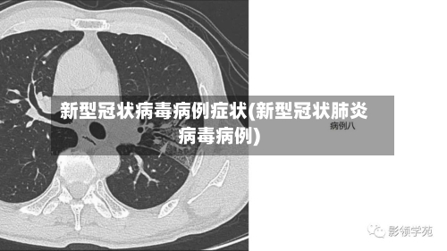 新型冠状病毒病例症状(新型冠状肺炎病毒病例)