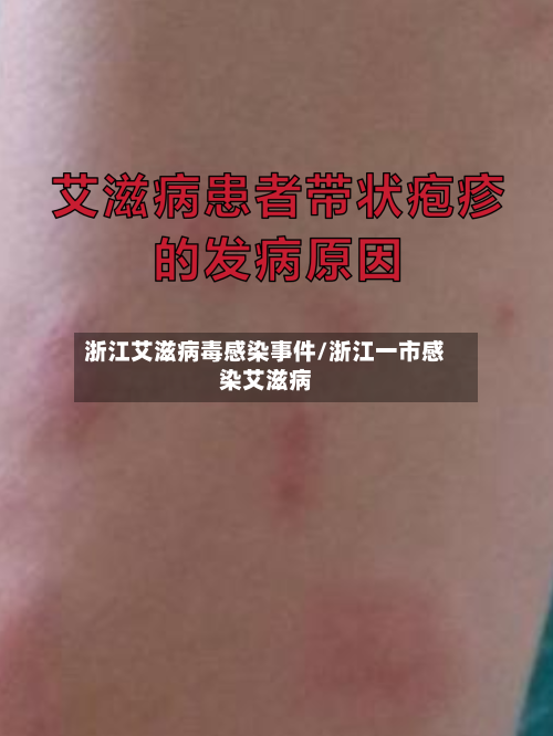 浙江艾滋病毒感染事件/浙江一市感染艾滋病-第2张图片