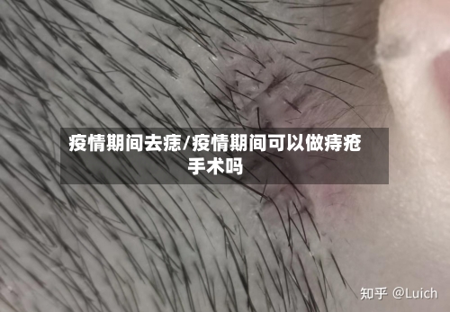 疫情期间去痣/疫情期间可以做痔疮手术吗-第3张图片