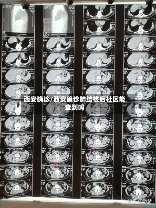 西安确诊/西安确诊肺结核后社区能查到吗-第2张图片